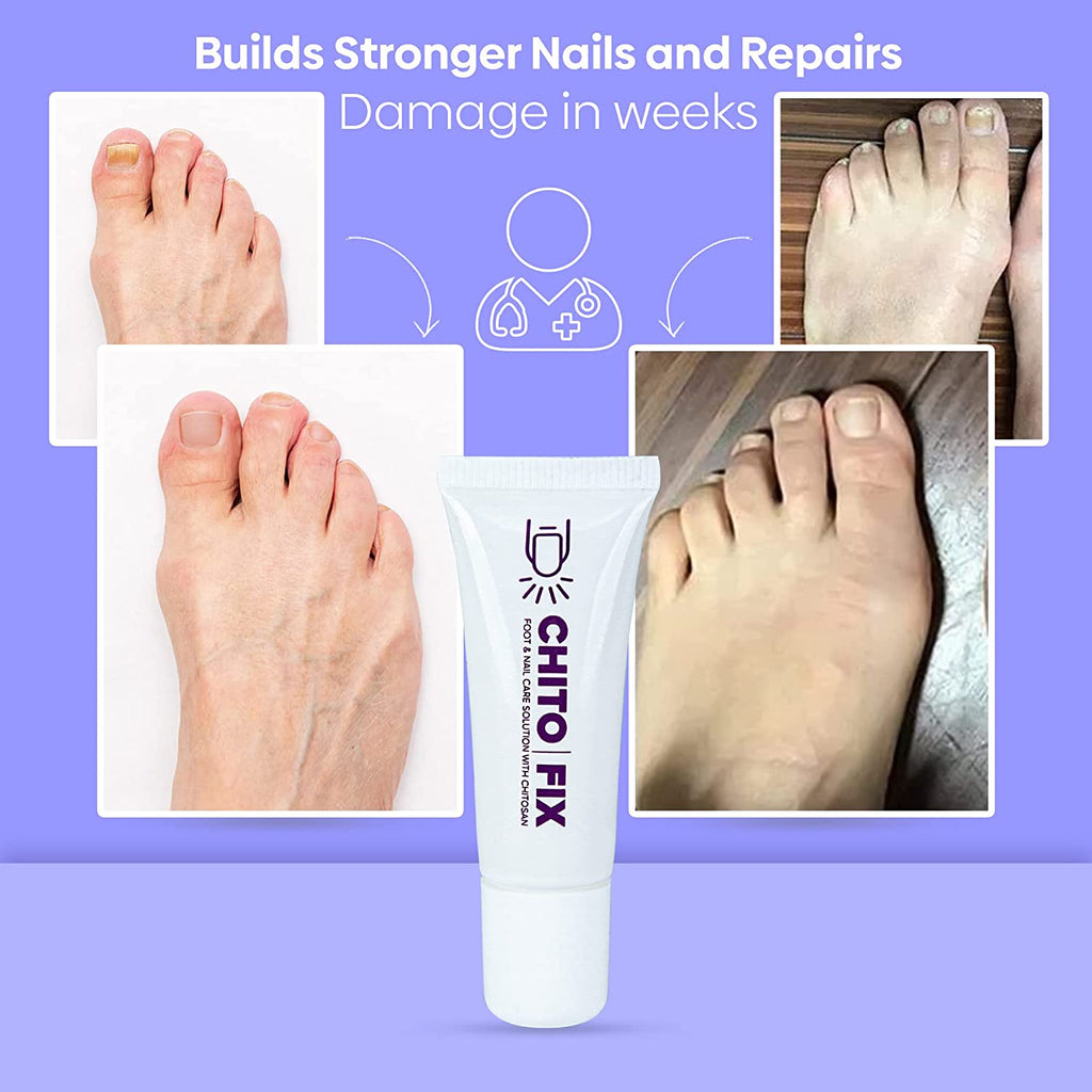 Chitofix Nail Care Cream with Chitosan - Extra Strength Formula for Toenail and Fingernail